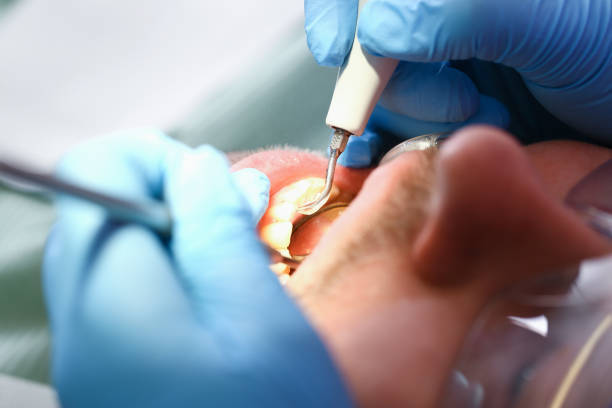 Best Dental Abscess Treatment in , OH