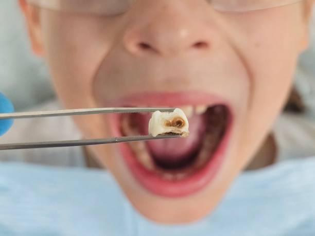 Best Knocked-Out Tooth (Avulsed Tooth) Treatment in , OH